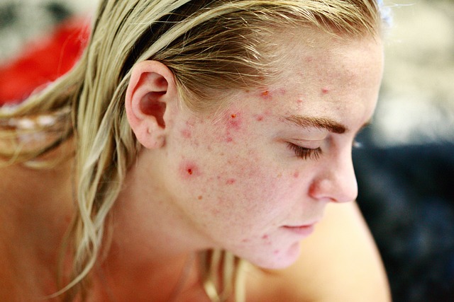 5 Simple Guidelines For Your Successful Acne Skin Treatment