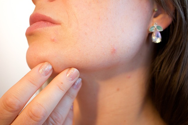 Getting Rid Of Acne Scars - The Ultimate Guide